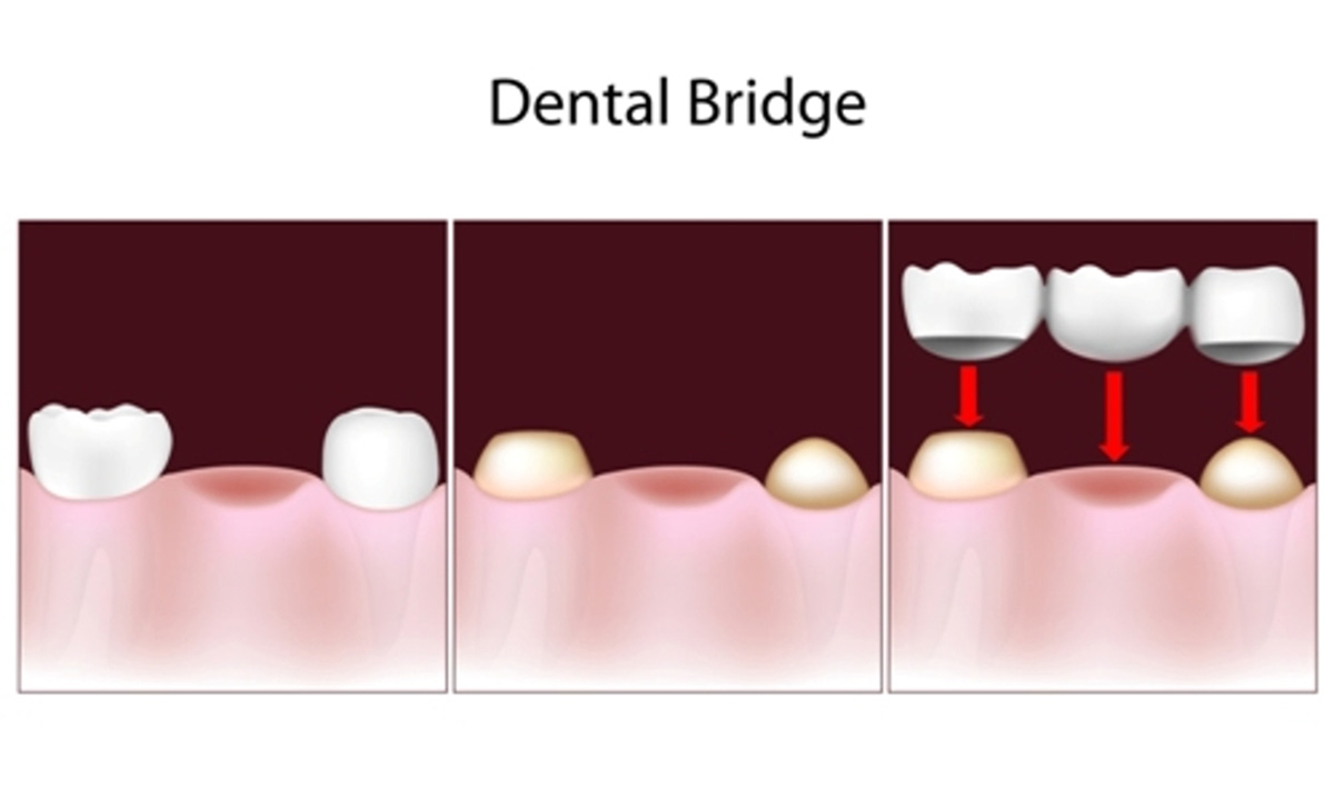 Dental Bridges Near You in Main Street