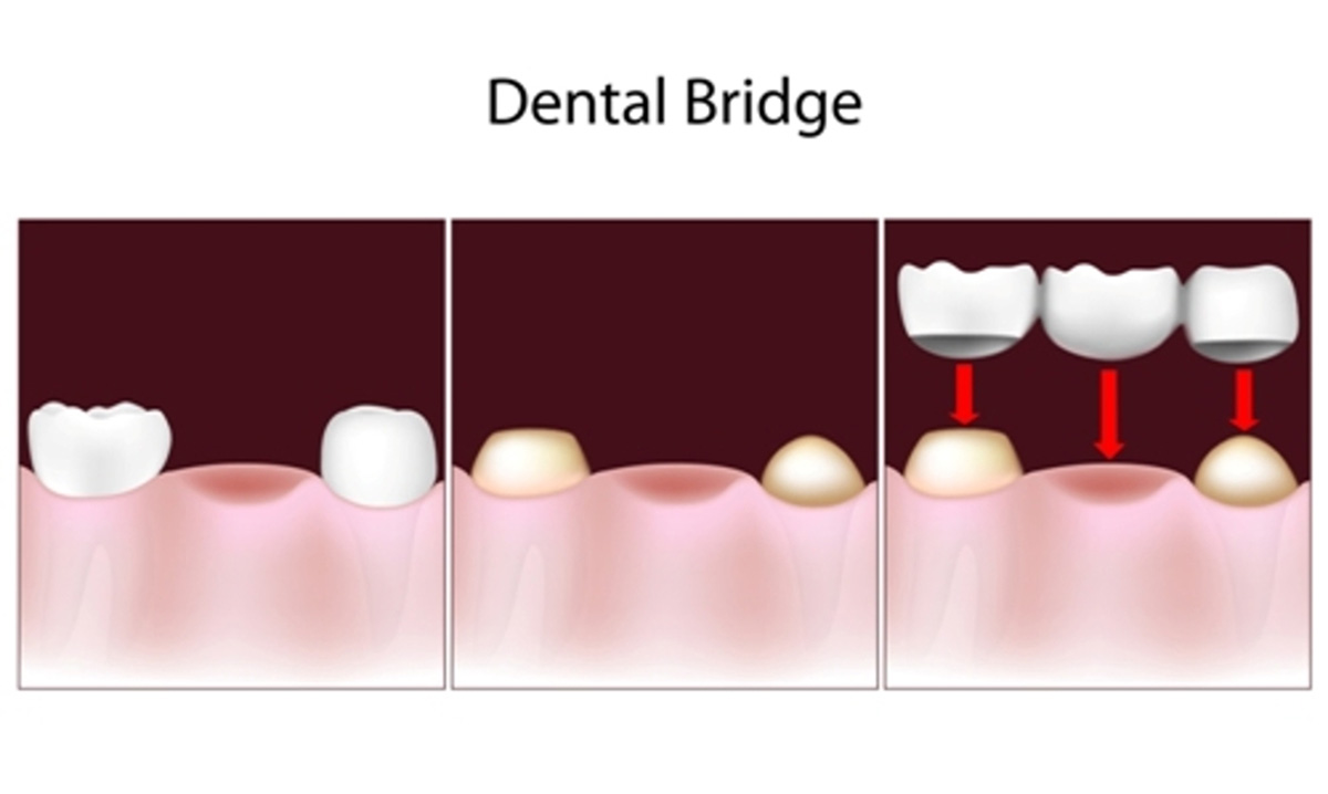 Dental Bridges in Main Street