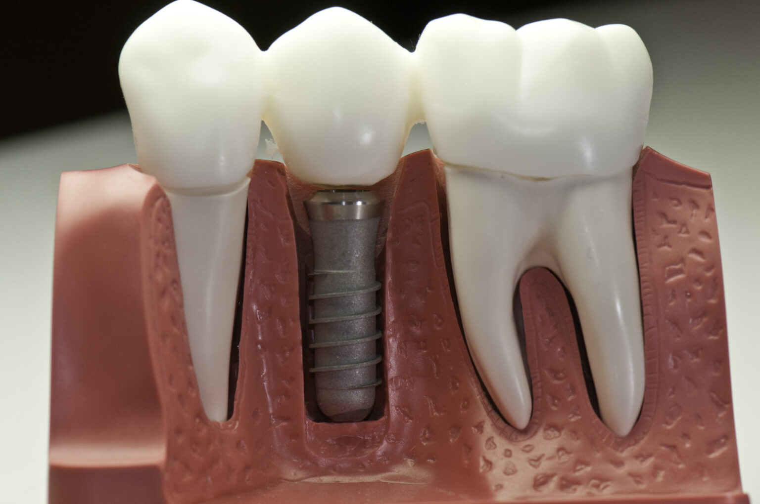 dental implants in Main Street