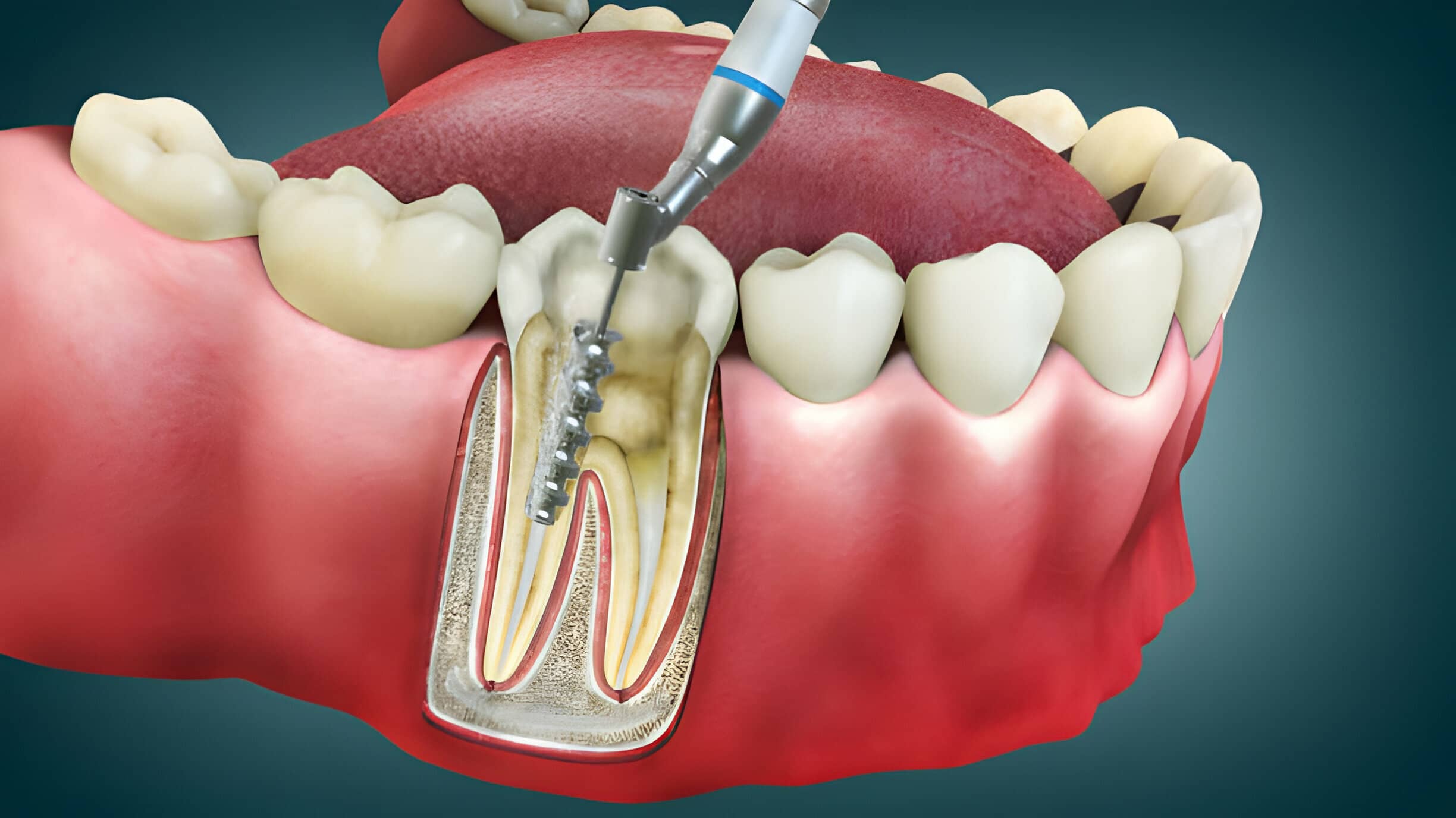 When Do You Need a Root Canal? "Signs and Symptoms"