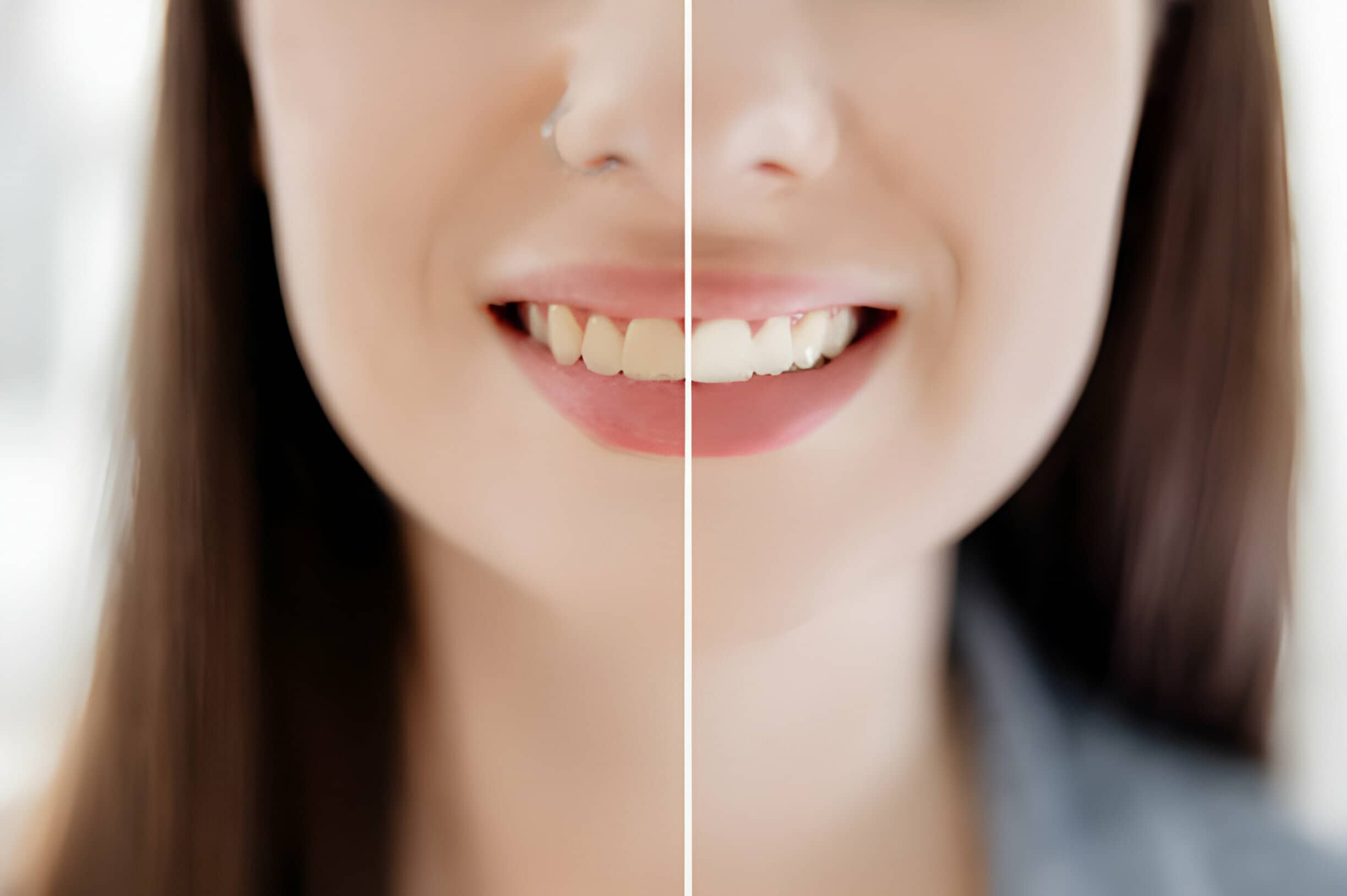 How Can I Permanently Whiten My Teeth?
